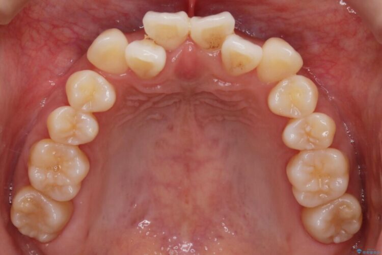 【20代女性】抜歯無しで前歯のがたがたを改善する 治療前画像