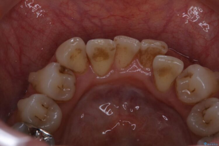【40代女性】インビザライン治療中のクリーニング 治療前画像