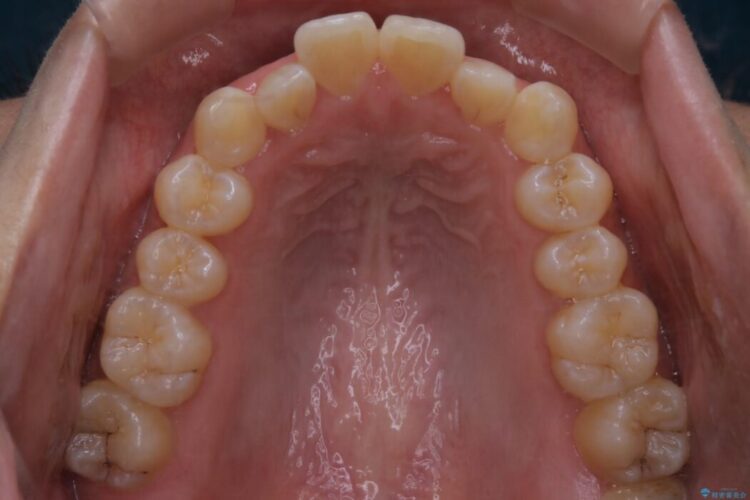 【20代女性】軽度の反対咬合を部分矯正でなおす 治療前画像