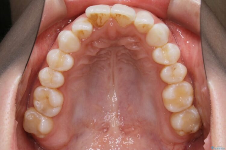 【20代女性】歯軸傾斜を改善して噛み合わせを正しくする 治療前画像