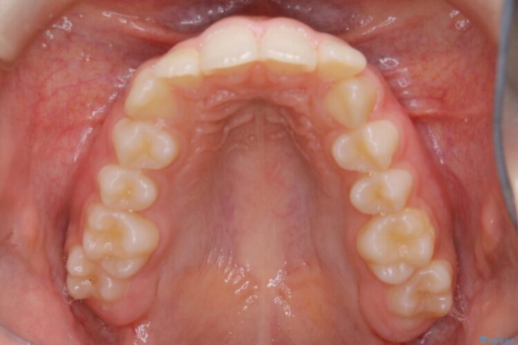 【10代女性】歯並びを整えて自信が持てる素敵な笑顔に 治療前画像