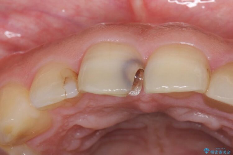 【30代男性】神経一歩手前の深い虫歯をセラミッククラウンで治療 治療前画像
