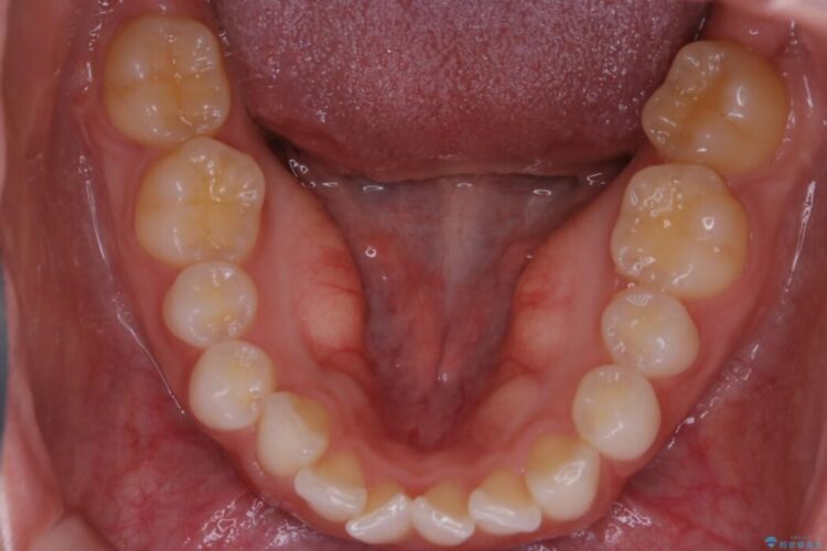 【20代女性】短期間でのインビザライン治療で見た目の悩みを改善する 治療前画像