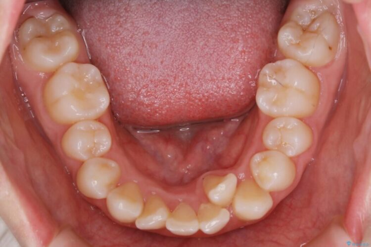 【20代女性】抜歯矯正で出っ張った口元を改善する 治療前画像