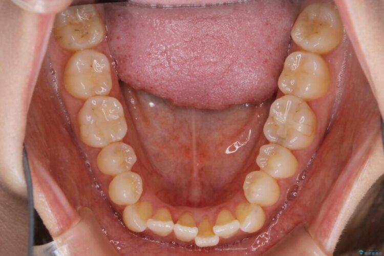 【30代女性】短期間で非抜歯による反対咬合(受け口)の改善 治療前画像