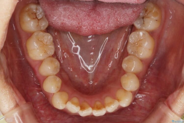 【20代女性】開咬の隙間と歯列の凸凹をまとめて改善する 治療前画像