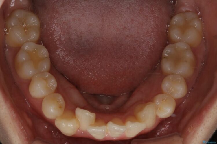 【20代女性】非抜歯でもガタガタを改善するインビザライン矯正 治療前画像