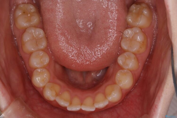 【20代女性】前歯が噛み合わない!開咬（オープンバイト）の矯正治療 治療前画像