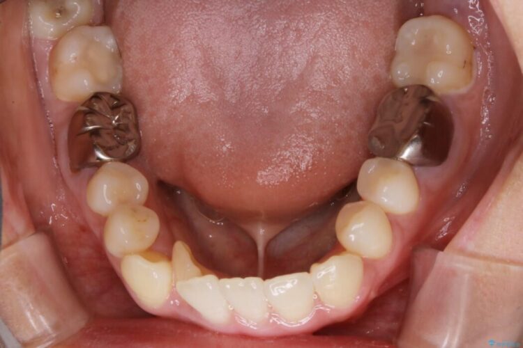 【20代女性】隠れた前歯とガタつきをきれいな歯列弓へ 治療前画像