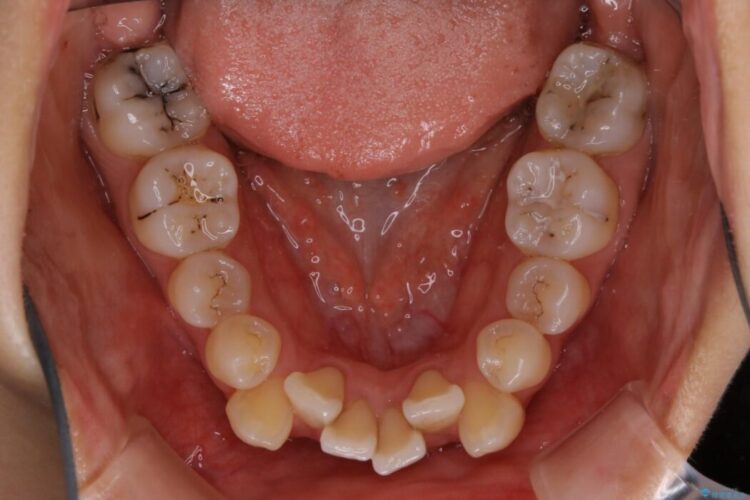 【20代女性】抜歯ワイヤー矯正で八重歯がスッキリ 治療前画像