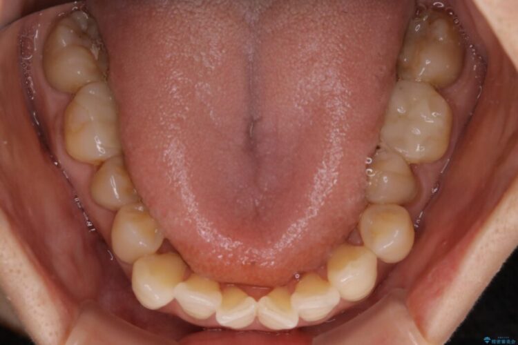 【30代女性】前歯の反対咬合をマウスピースで改善 治療前画像