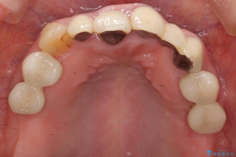 【40代女性】前歯のかぶせ物をセラミックでやりなおす 治療前画像