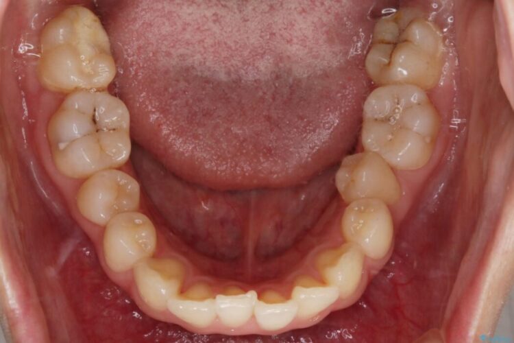 【20代女性】ブライダルに向けた矯正できれいなスマイルラインへ 治療前画像