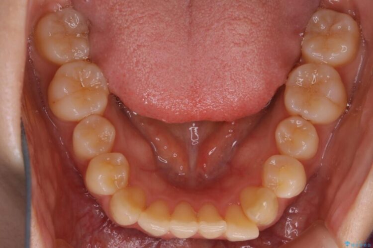 【20代 女性】インビザラインで短期間矯正 治療前画像