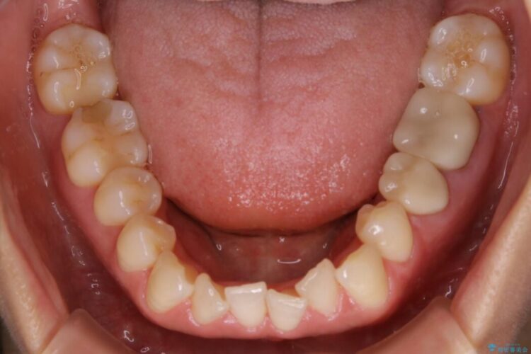 【30代女性】非抜歯で噛み合わせとガタつきの改善 治療前画像