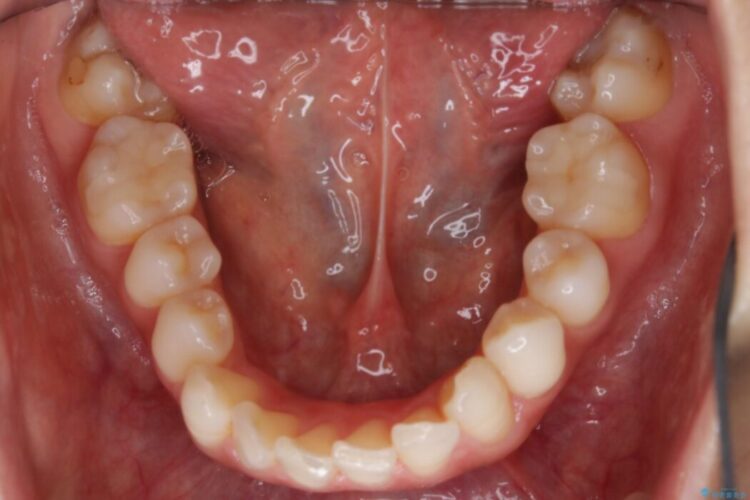 【30代女性】噛み合わせのズレを解消する 治療前画像