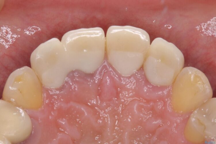 【50代男性】前歯の被せ物を新しく 治療前画像