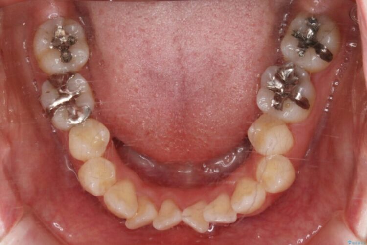 【30代女性】インビザラインで抜歯矯正 治療前画像