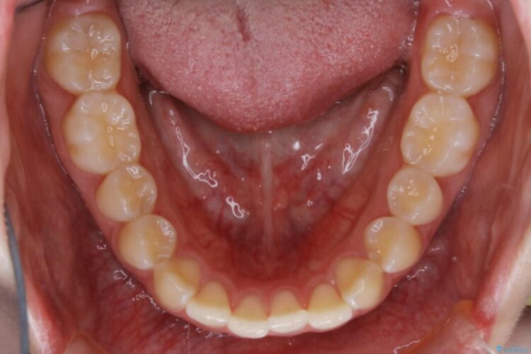 【20代女性】噛み合わせのズレからくるガタついた歯列をインビザライン矯正治療 治療前画像