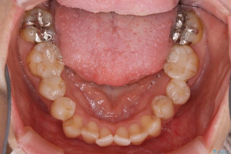 【20代女性】非抜歯で歯列をコンパクトに 治療前画像