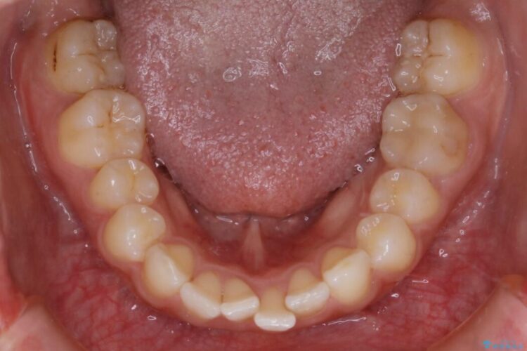 【20代女性】ゴムかけを併用し噛み合わせを改善!インビザライン矯正 治療前画像