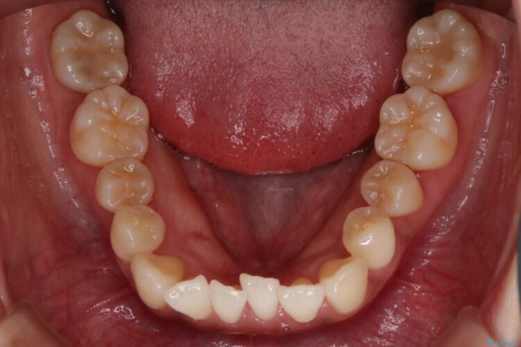 【20代女性】抜歯無しで前歯のがたがたを改善する 治療前画像