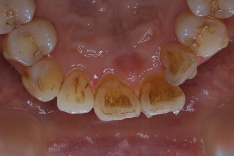 【40代女性】インビザライン治療中のクリーニング 治療前画像