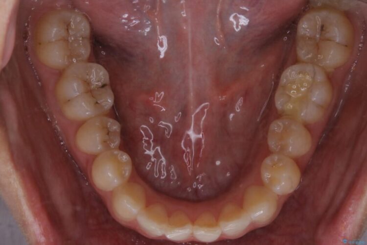 【20代女性】軽度の反対咬合を部分矯正でなおす 治療前画像
