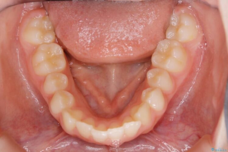 【10代女性】歯並びを整えて自信が持てる素敵な笑顔に 治療前画像