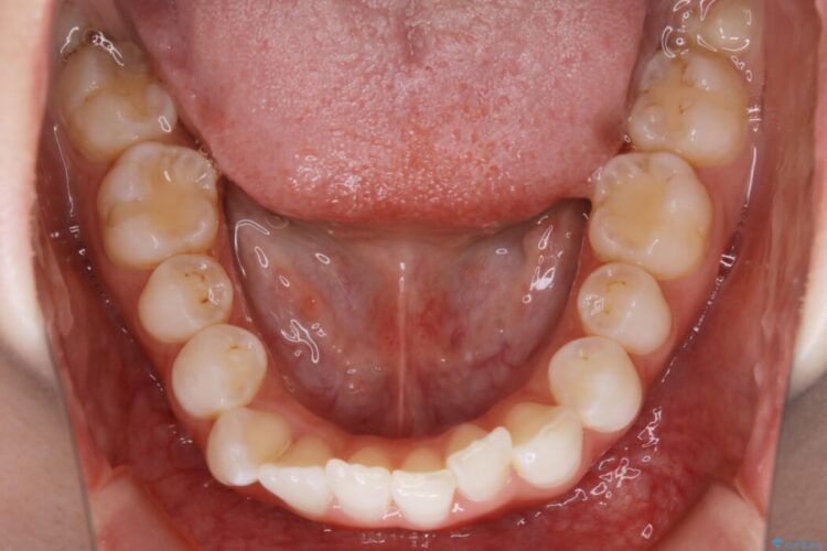 【20代女性】歯軸傾斜を改善して噛み合わせを正しくする 治療前画像