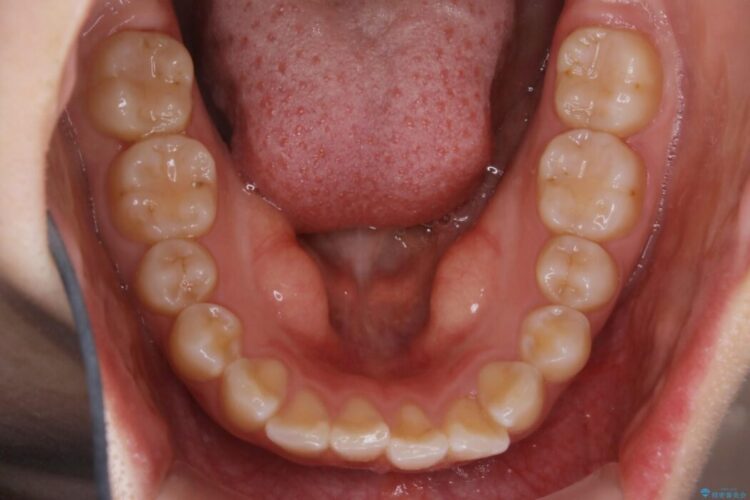 【30代女性】歯を長持ちさせるための咬合調整 治療前画像