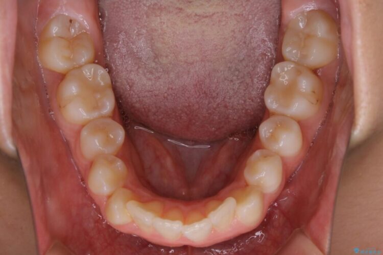 【20代女性】口元を引っ込めたい Eラインの改善 治療前画像