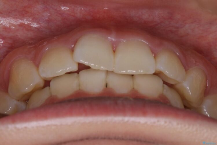 【20代女性】噛み合わせのズレからくるガタついた歯列をインビザライン矯正治療 治療前画像