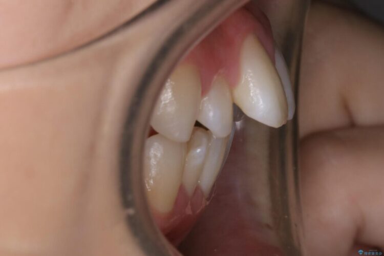 【20代女性】抜歯矯正で出っ張った口元を改善する 治療前画像