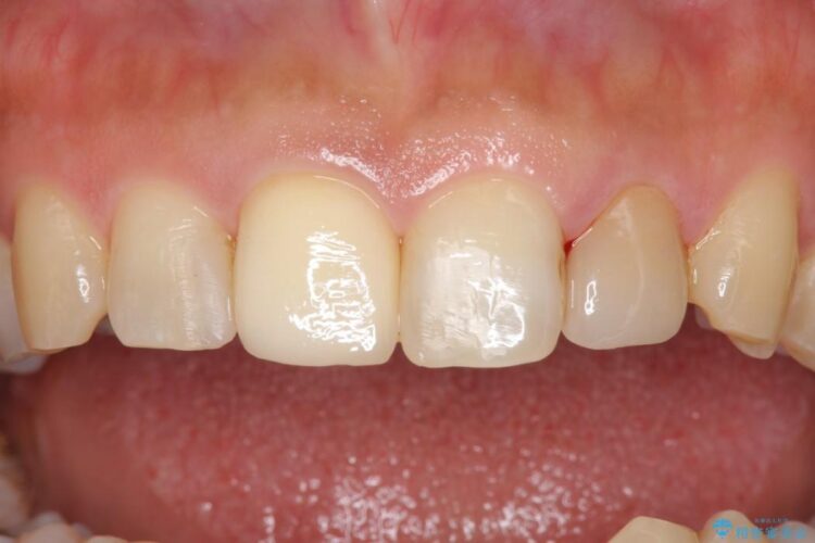 【30代男性】神経一歩手前の深い虫歯をセラミッククラウンで治療 アフター