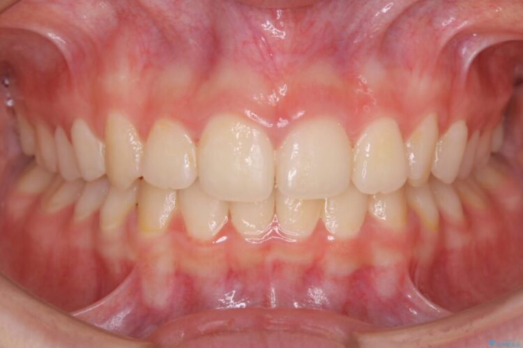 【10代女性】歯並びを整えて自信が持てる素敵な笑顔に 治療後画像