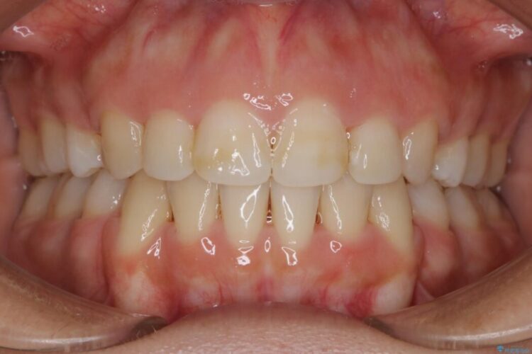 【20代女性】口元を引っ込めたい Eラインの改善 治療後画像