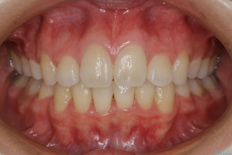 【20代女性】抜歯矯正で出っ張った口元を改善する 治療後画像