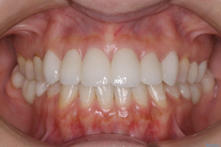 【30代女性】前歯の見た目をセラミッククラウンで変える 治療後画像