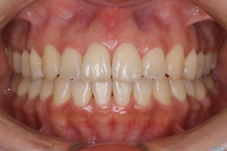 【20代女性】開咬の隙間と歯列の凸凹をまとめて改善する 治療後画像