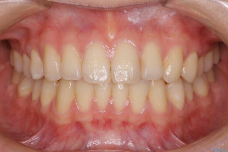 【20代女性】気になる部分だけをマウスピース矯正 治療後画像