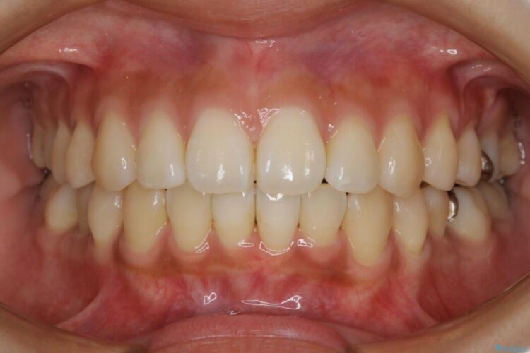 【20代女性】非抜歯でマウスピースの限界に挑戦する矯正治療 治療後画像