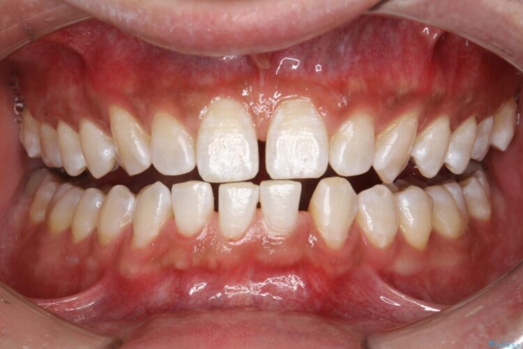 【30代男性】ホワイトニングでできる限り白くしたい 治療後画像