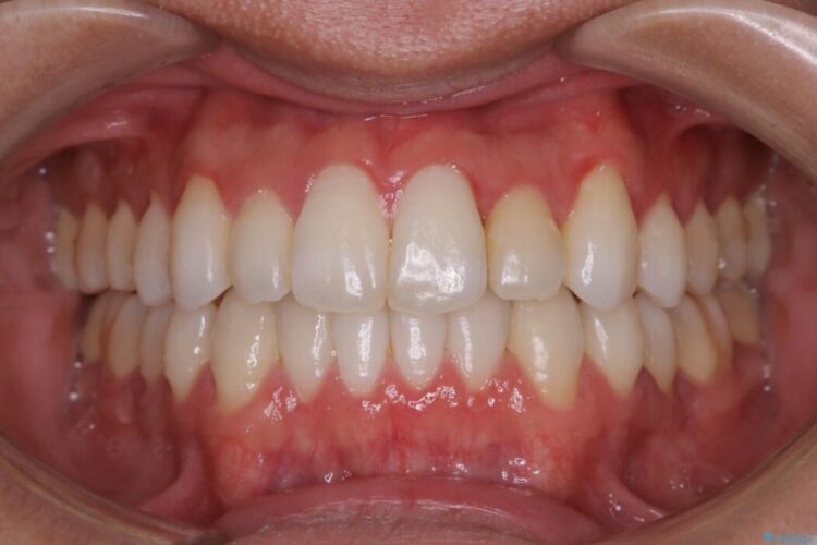 【20代男性】上顎のガタガタな歯列をインビザラインで矯正治療 治療後画像