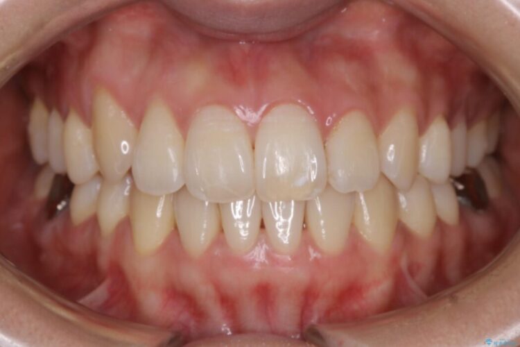 【20代女性】隠れた前歯とガタつきをきれいな歯列弓へ 治療後画像