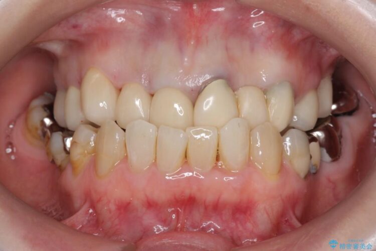 【40代女性】前歯のかぶせ物をセラミックでやりなおす 治療後画像