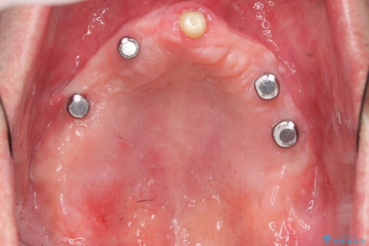 【50代男性】重度の歯周病をインプラントを用いた上顎義歯（入れ歯）で補綴治療 治療後画像