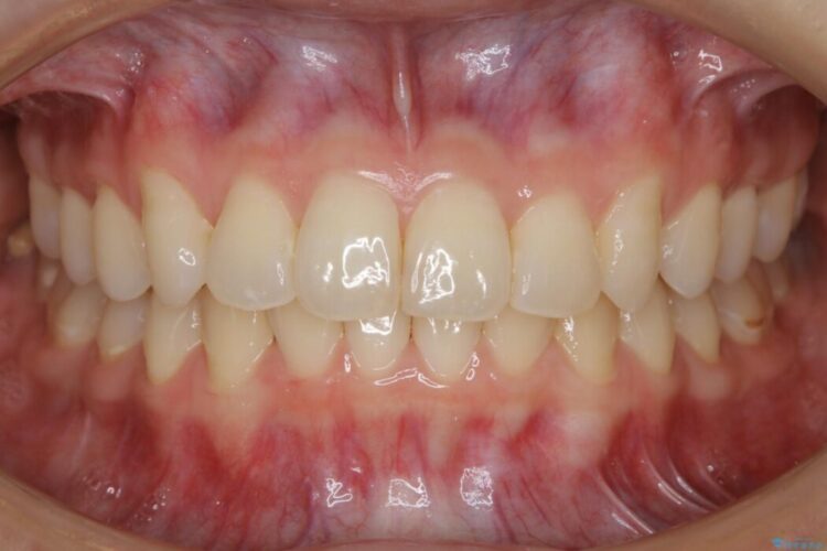 【20代女性】ブライダルに向けた矯正できれいなスマイルラインへ 治療後画像