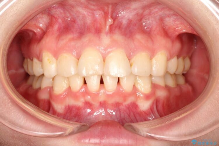 【20代女性】出っ歯の矯正 治療例 治療後画像