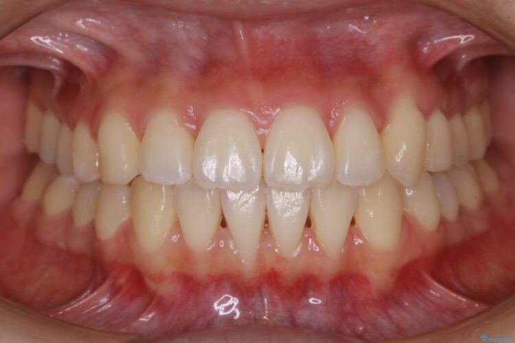 【20代女性】前歯の真ん中（正中）のズレとガタつきを効率よく矯正する 治療後画像